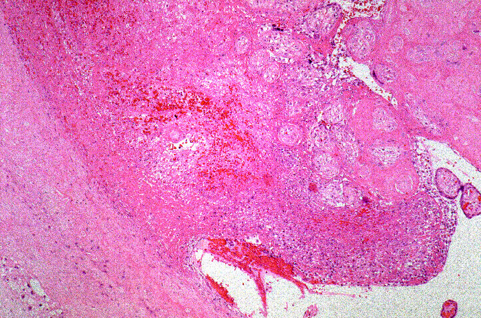 Photomicrograph describing tuberculosis of the placenta.Adapted from Public Health Image Library (PHIL), Centers for Disease Control and Prevention.[20]