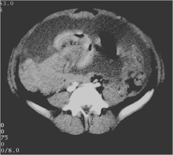 File:CT Thickened peritoneum and ascites.png