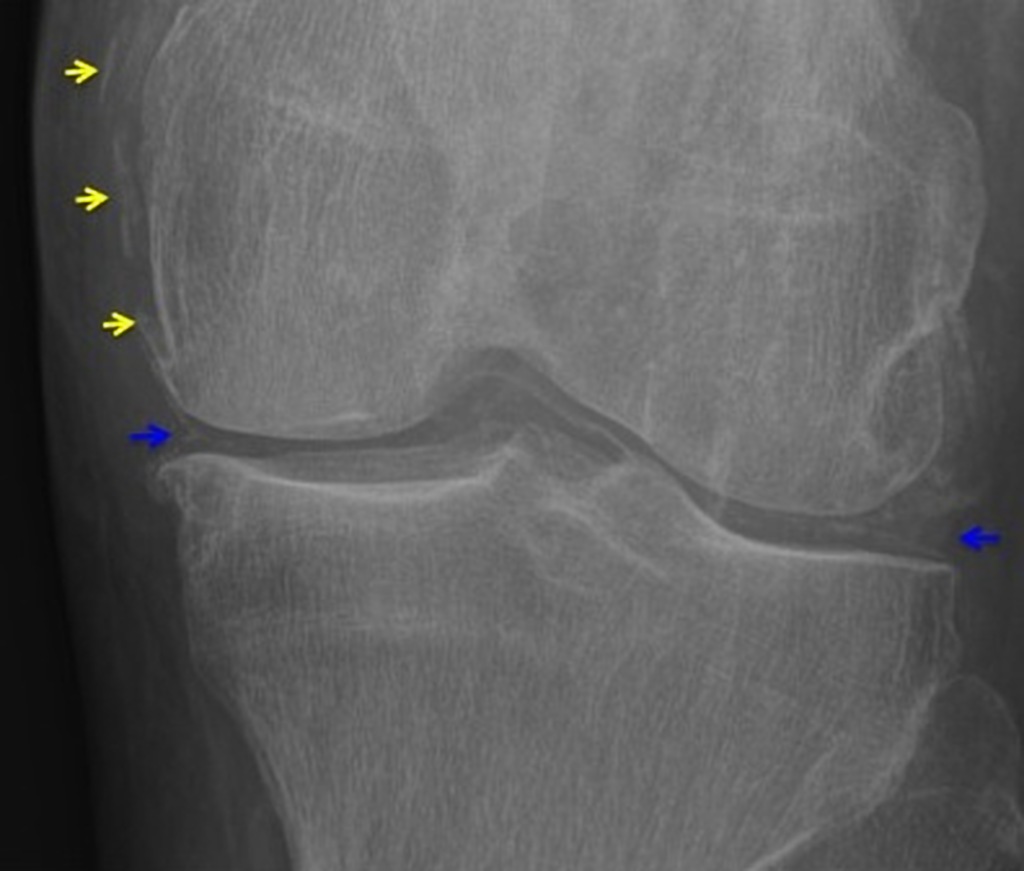 Pseudogout in knee, source: File:Case courtesy of Dr Charlie Chia-Tsong Hsu, Radiopaedia.org, rID 31099.jpg