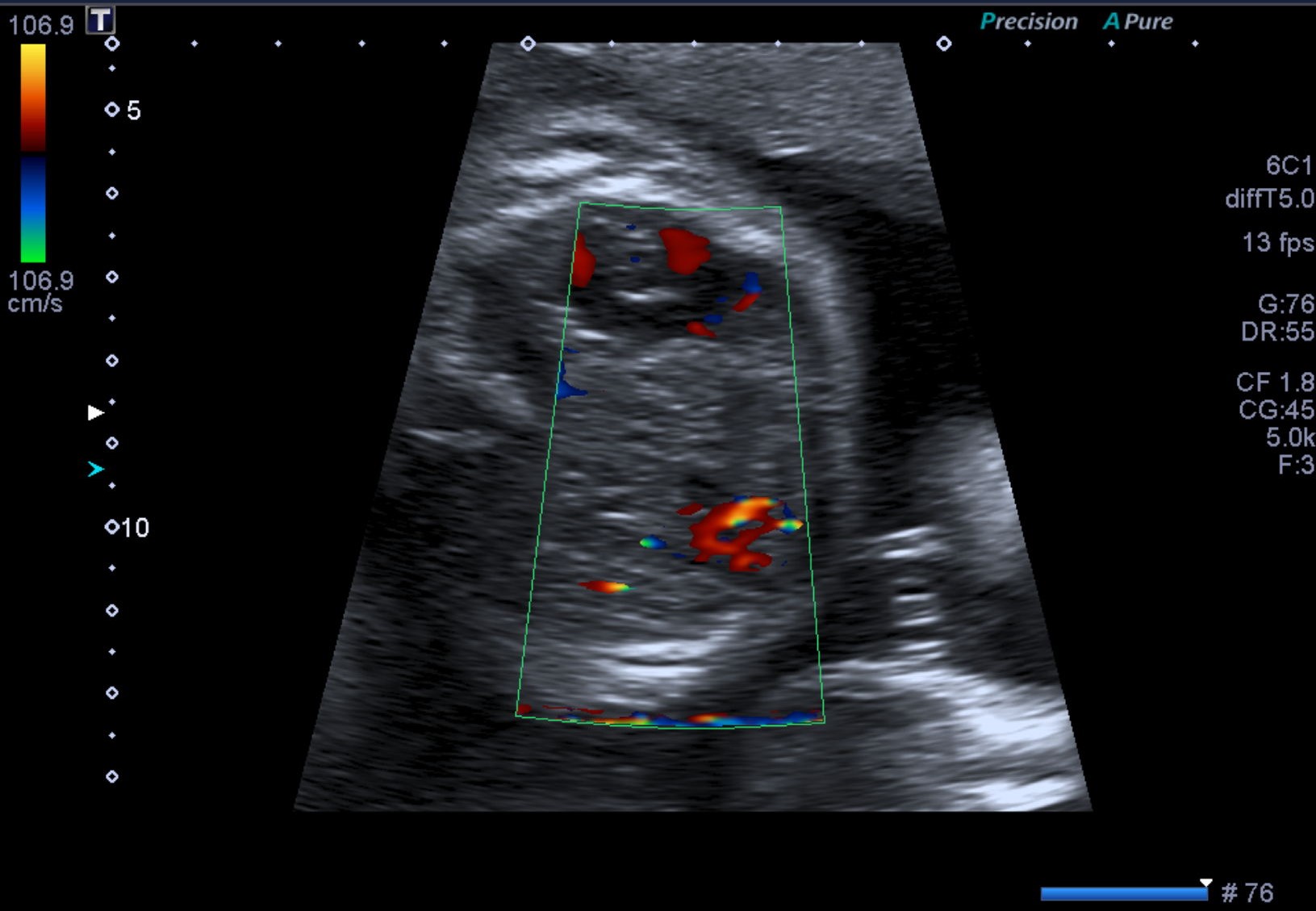 File:Congenital-diaphragmatic-hernia-right-sided-1.jpg
