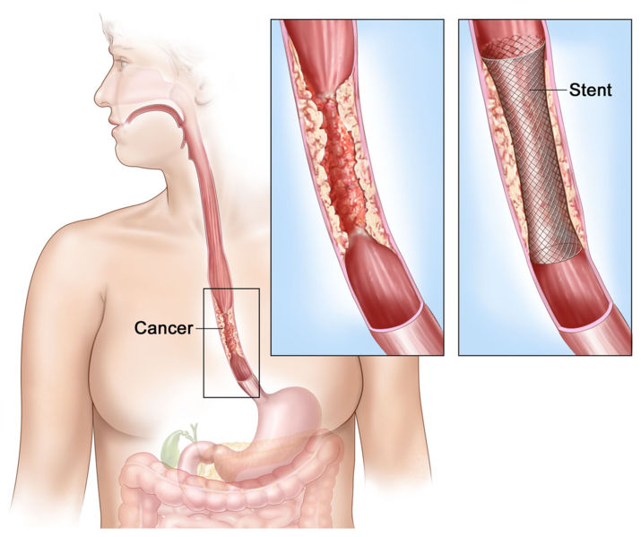 Shows cancer blocking esophagus. Insets show enlarged area of cancer and a stent placed in the esophagus to keep it open.
