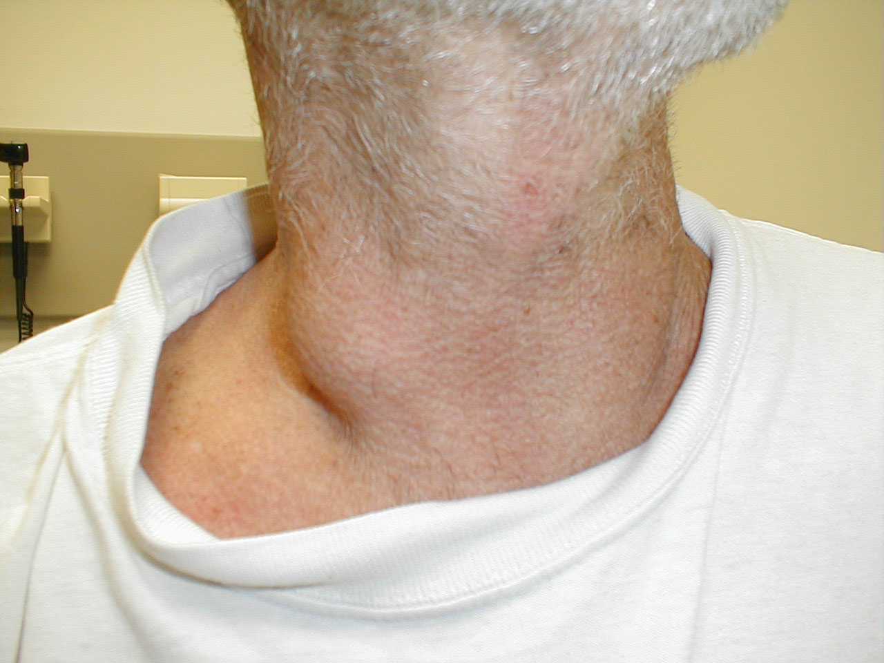 Cervical Adenopathy: Large right anterior cervical lymph node.