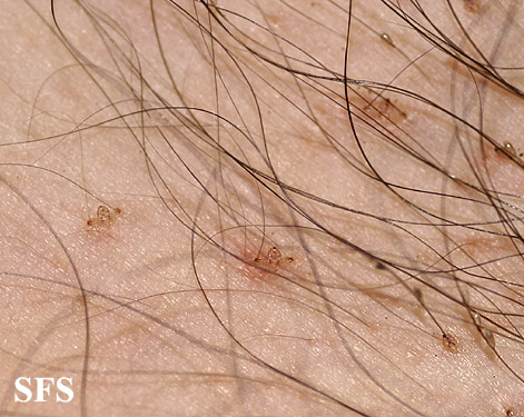 Pediculosis pubis. Permission from Dermatology Atlas.[11]