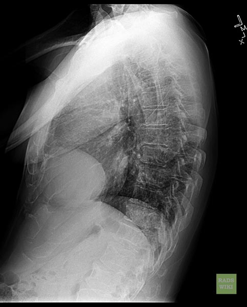 Chest x-ray - Lateral view: Pericardial cyst