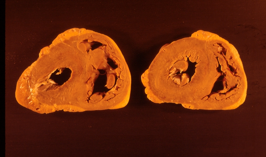 File:Scleroderma heart 4.jpg