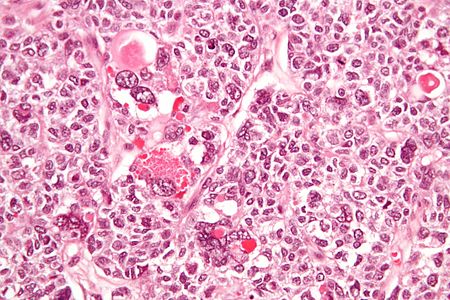 File:450px-Juvenile granulosa cell tumour - very high mag.jpg