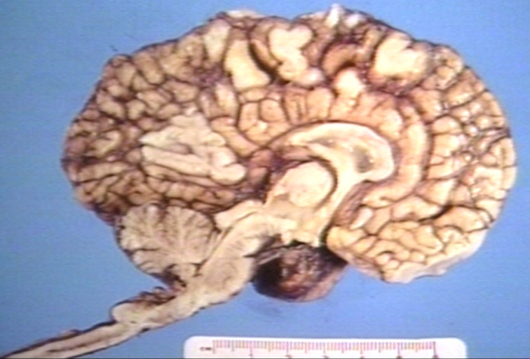 Brain: Arnold Chiari Malformation; Type II