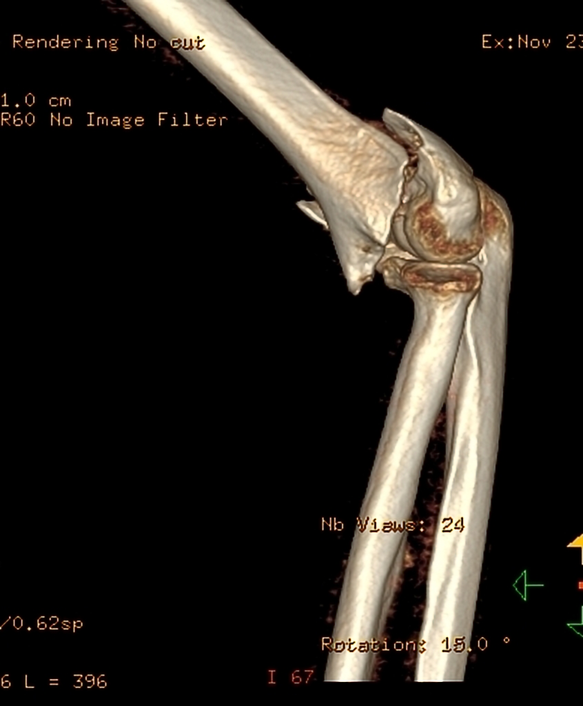 File:Displaced-t-condylar-and-supracondylar-fracture-of-the-distal-humerus (6).jpg