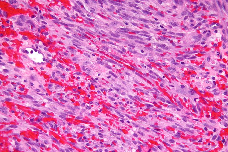 Kaposi sarcoma observed under high magnification[8]