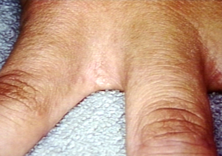 Skin: Scabies, Vesicular; Vesiculobullous Diseases