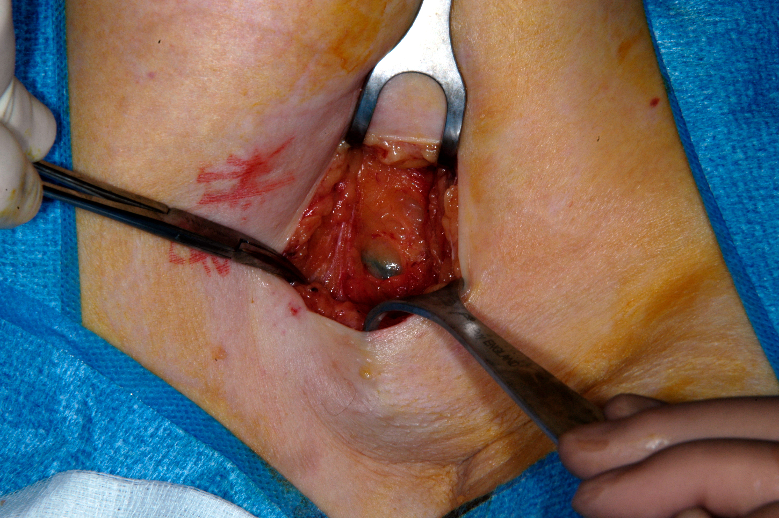 File:Sentinel lymph node (axilla) (1).jpg