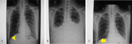 File:Xray chylothorax.png