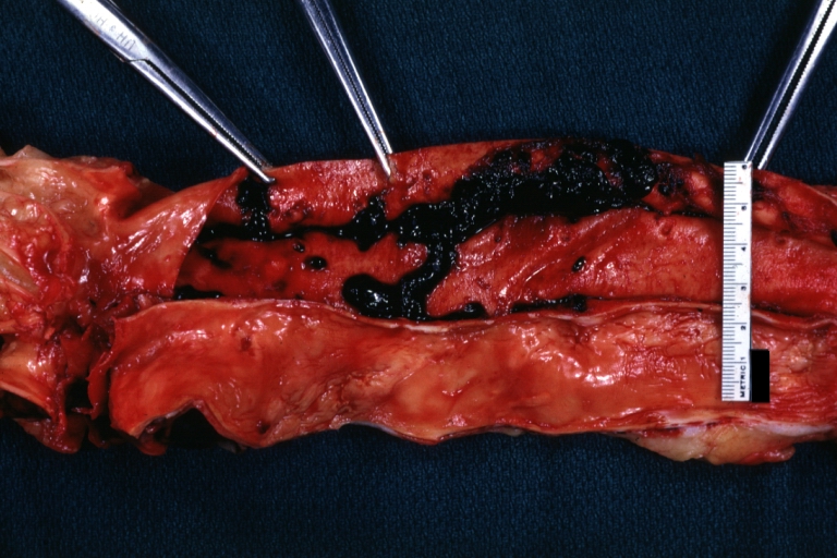 Dissecting Aneurysm: Gross natural color descending aorta opened into false channel