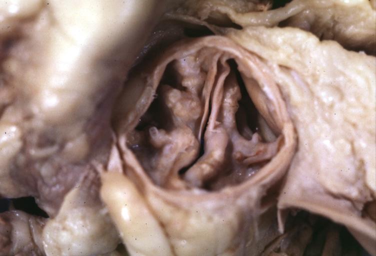 Aortic Stenosis Bicuspid: Gross; fixed tissue. Bicuspid valve and false raphe classical