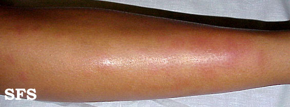 .:Erythema nodosum Adapted from Dermatology Atlas.[14]