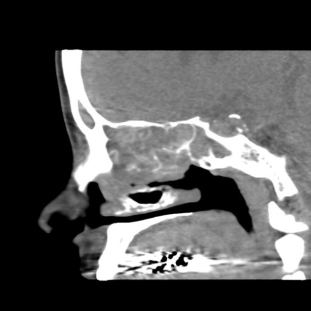 Sagittal non contrast CT of esthesioneuroblastoma[2]