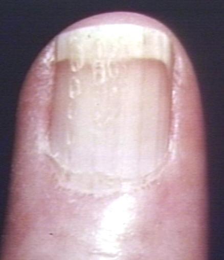 Scleroderma nail.jpg