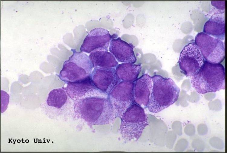 AML-M3 - also called promyelocytic leukemia. Hypergranular morphology with most cells containing abundant large granules.