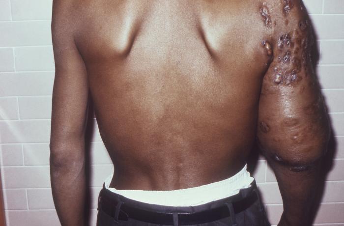 Posterior perspective of patient with nocardiosis infection of his right upper arm due to Gram-positive Nocardia brasiliensis bacteria. From Public Health Image Library (PHIL). [5]