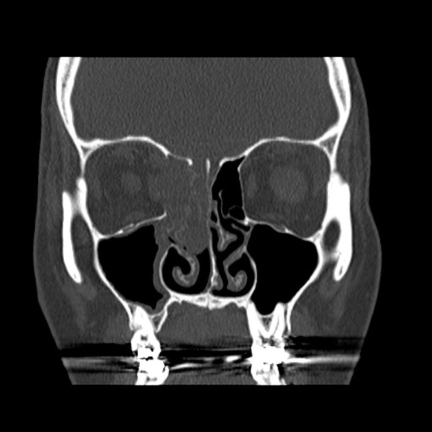 Coronal bone window CT scan of esthesioneuroblastoma[2]