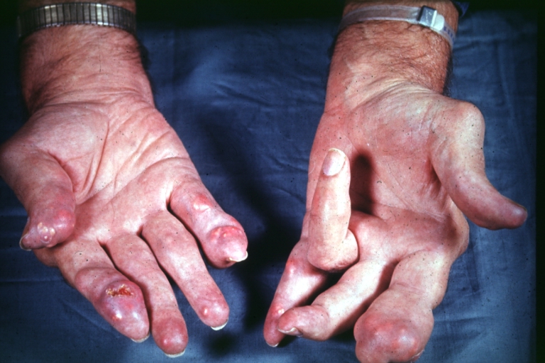 Hand: Gout: Gross natural color