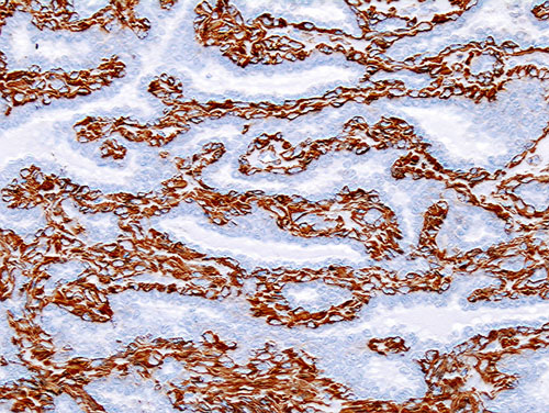 Histopathology of intraductal papilloma of the breast by excisional biopsy. Immunostaining for alpha-smooth muscle actin.