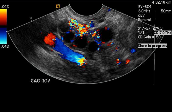 Ovarian-hyperstimulation-004.jpg