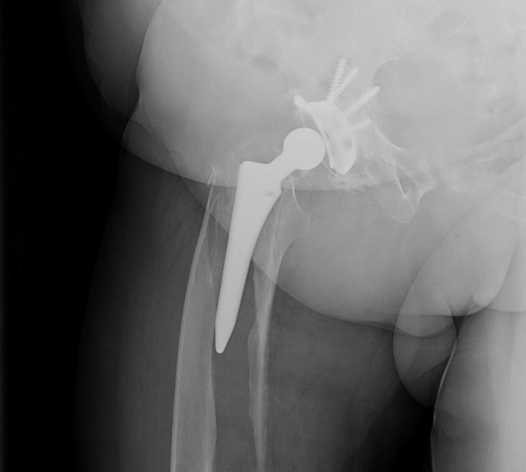 Vancouver type B2 periprosthetic femur fracture of the right hip.