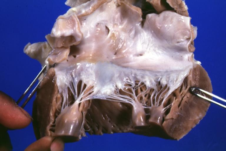 Anomalous Origin Coronary Artery: Gross left atrium and mitral valve normal