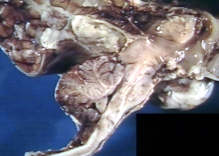 Brain: Arnold Chiari Malformation, Type II; Meningomyelocele, Meningitis, Close-up of Previous one