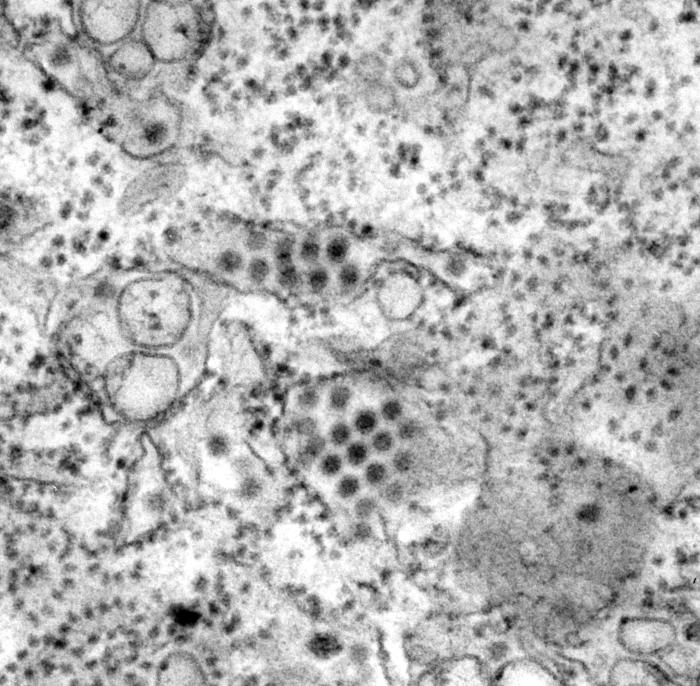 Transmission electron micrograph (TEM) depicts a number of round, Dengue virus particles that were revealed in this tissue specimen. From Public Health Image Library (PHIL). [1]