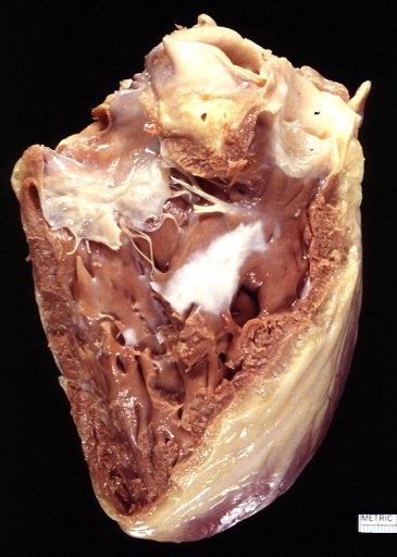 Endocardial fibrosis 1.jpg