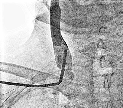 Complication during subclavian vein cannulation. Copyleft image courtesy of C. Michael Gibson.