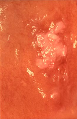 Clinically, a leukoplakia on left buccal mucosa. However, the biopsy showed early squamous cell carcinoma. The lesion is suspicious because of the presence of nodules.]]