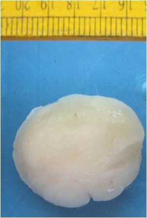 Neurofibroma: Nodular mass with whitish glistening cut surface.[12]