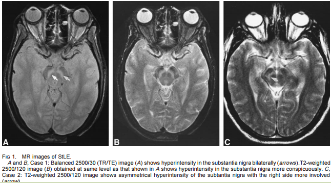 File:St. Louis encephalitis MRI.png