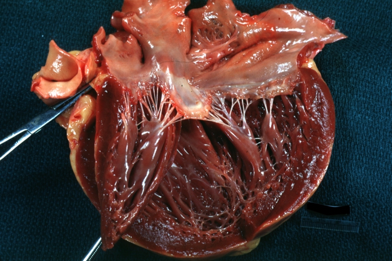 The heart in sarcoidosis 001.jpg