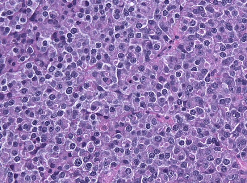 Pituitary adenoma of lactotroph cells (prolactin producing) - by Jensflorian source: Librepathology