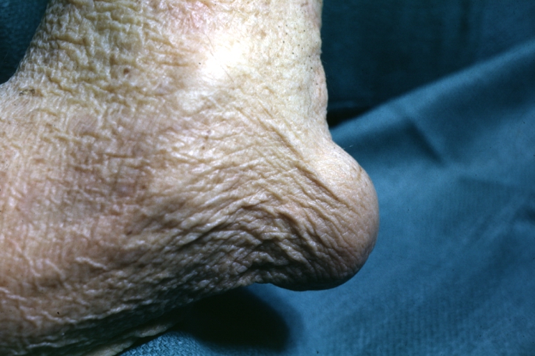 Bone: Gout: Gross close-up of elbow with enlargement of proximal radius due to gout