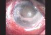 Corneal edema and severe anterior chamber exudation[7]
