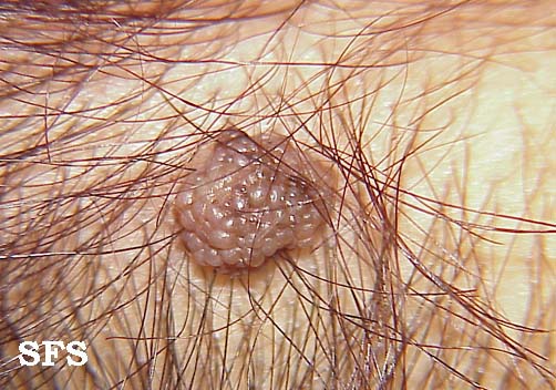 Melanocytic naevi. Adapted from Atlas<ref name="www.atlasdermatologico.com.br">"Dermatology Atlas".