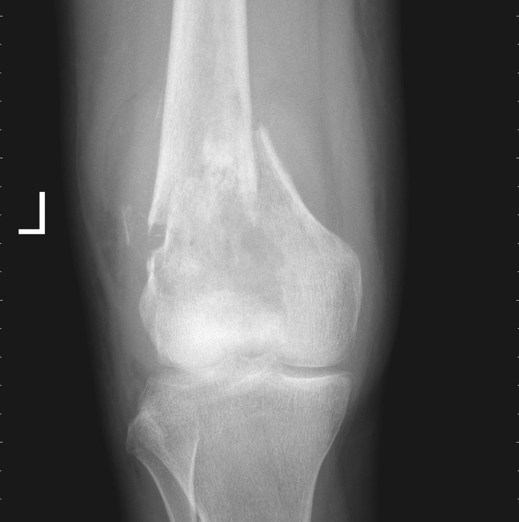 File:Pathological-femur-fracture.jpg