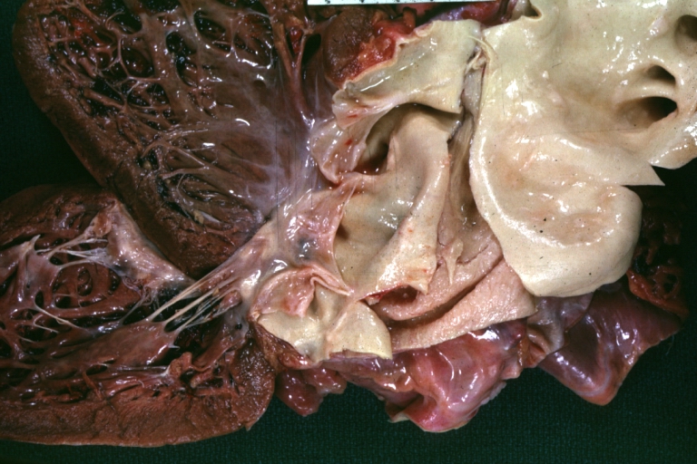 Dissecting Aneurysm: Gross, an excellent example of type I lesion
