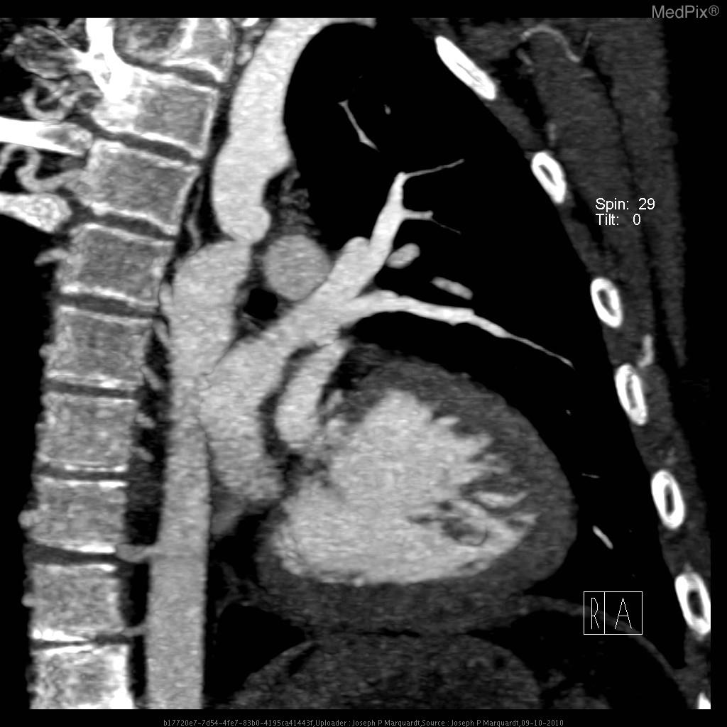 File:CT Angiography Coarctation of Aorta Original Image 6.jpg