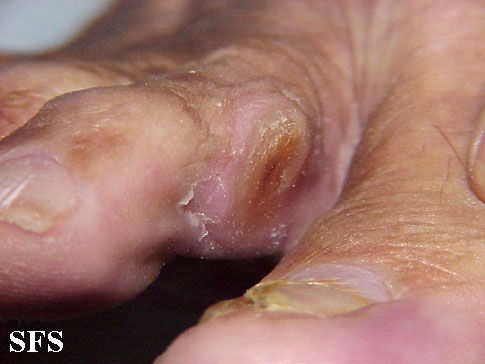 Callus. Adapted from Dermatology Atlas.[1]