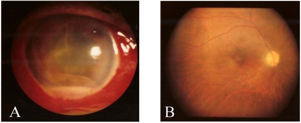 (A) Severe conjunctival injection, subconjunctival hemorrhage, corneal stromal edema, and hypopyon (B) Fundus photograph shows a mild pale color of optic disc & macular degeneration[29]