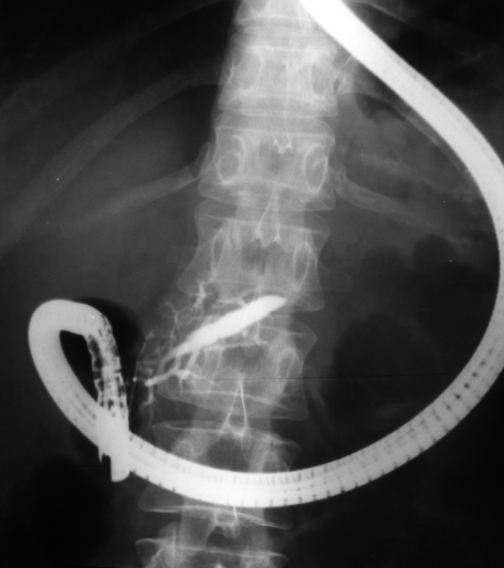 File:ERCP dilatation.png