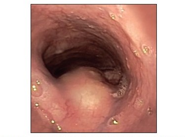 File:Endoscopic view of an esophageal duplication cyst.jpg