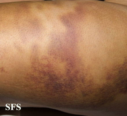File:Painful bruising syndrome09.jpg
