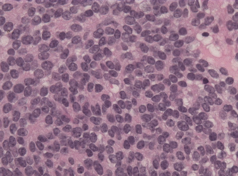 File:Pineal parenchymal tumor with intermediate differentiation microscopic 4.jpg